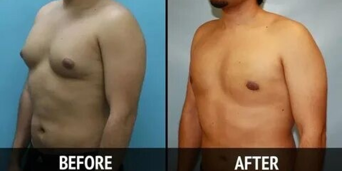 Gynecomastia Treatment in Islamabad – Your Complete Guide for Men’s Health