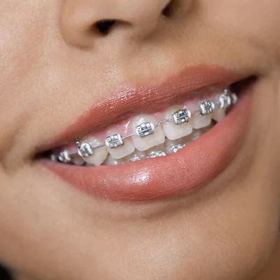Dental Braces in Islamabad Pakistan - Teeth braces Cost