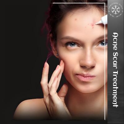 Acne Scar Treatment in Islamabad - ERCs